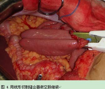 关于一次性胃肠吻合器在胃肠道恶性肿瘤切除后消化道重建术中的应用的毕业论文模板范文
